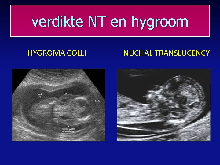 verdikte NT en hygroom HYGROMA COLLI NUCHAL TRANSLUCENCY 