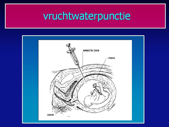 vruchtwaterpunctie 