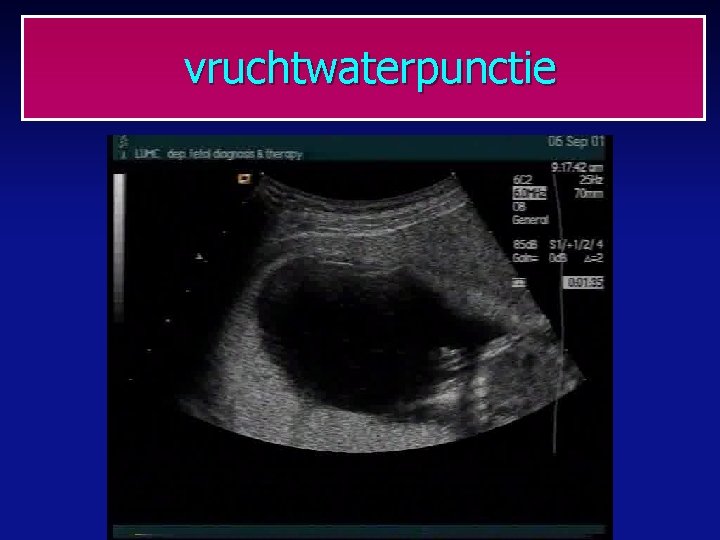 vruchtwaterpunctie 