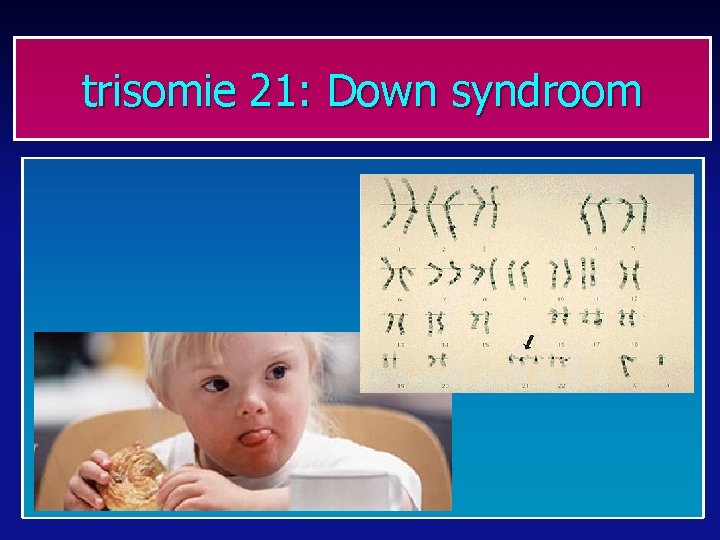 trisomie 21: Down syndroom 