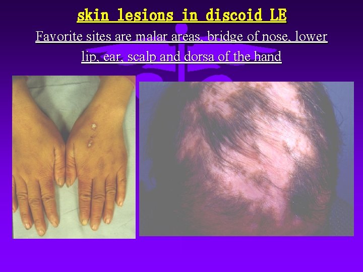 skin lesions in discoid LE Favorite sites are malar areas, bridge of nose, lower