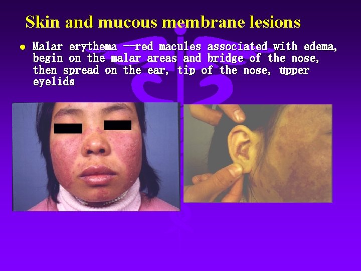 Skin and mucous membrane lesions l Malar erythema --red macules associated with edema, begin