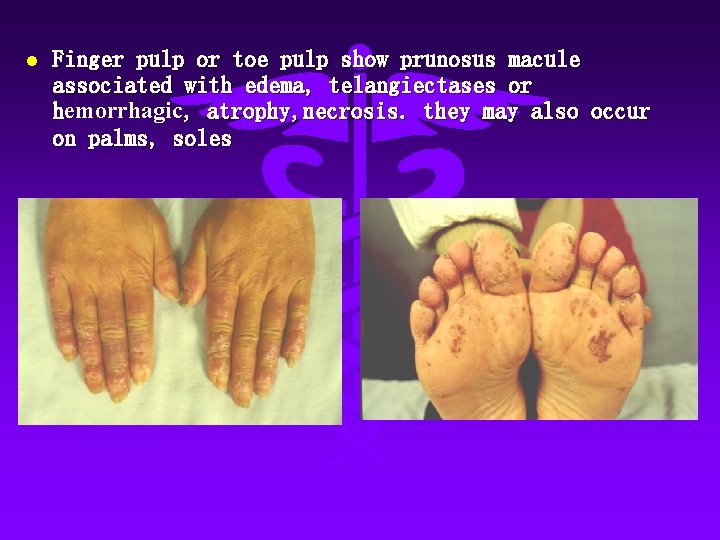 l Finger pulp or toe pulp show prunosus macule associated with edema, telangiectases or