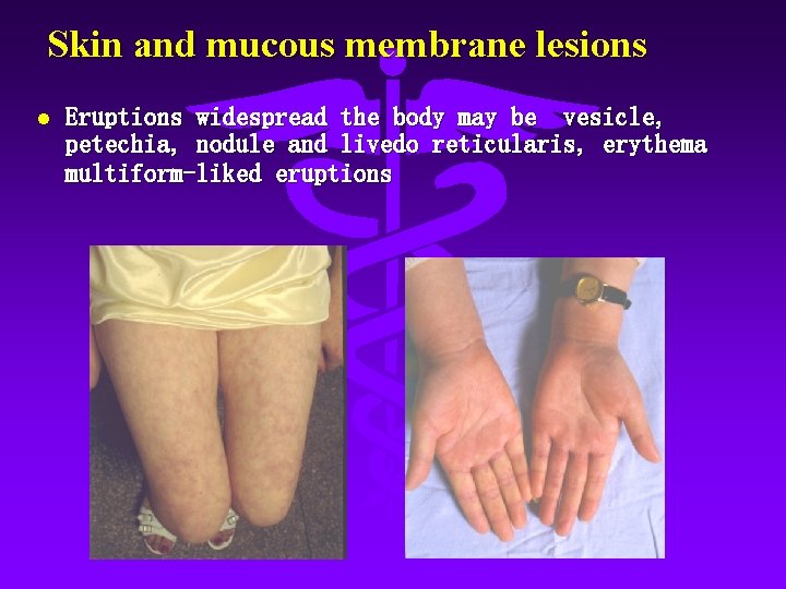 Skin and mucous membrane lesions l Eruptions widespread the body may be vesicle, petechia,