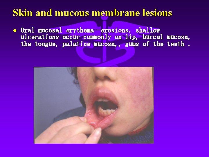 Skin and mucous membrane lesions l Oral mucosal erythema--erosions, shallow ulcerations occur commonly on