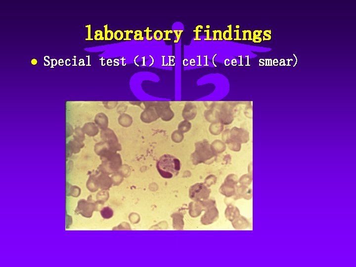 laboratory findings l Special test（1）LE cell( cell smear) 