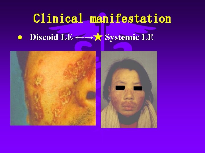 Clinical manifestation l Discoid LE ←→★ Systemic LE 