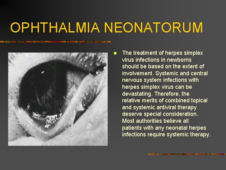 OPHTHALMIA NEONATORUM n The treatment of herpes simplex virus infections in newborns should be