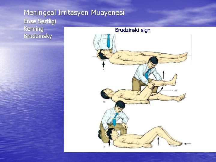 Meningeal Irritasyon Muayenesi Ense Sertligi Kerning Brudzinsky Brudzinski sign 