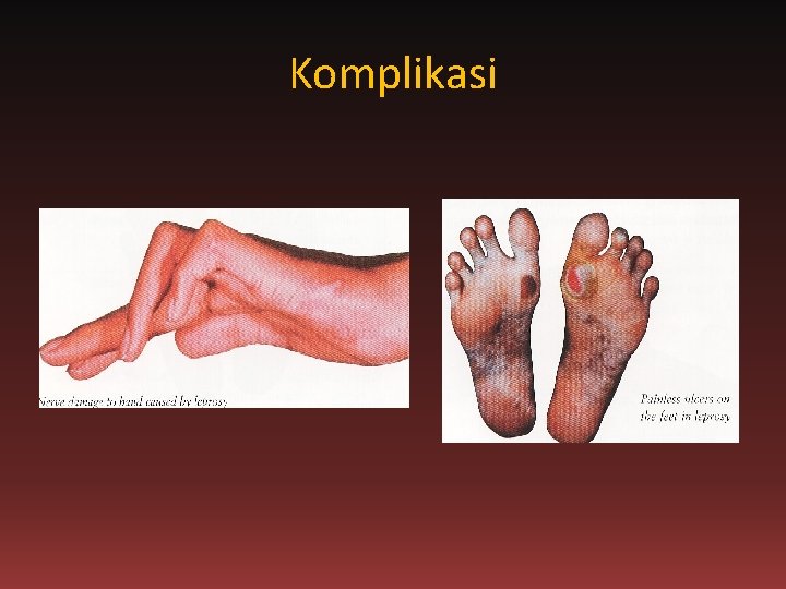 Komplikasi 