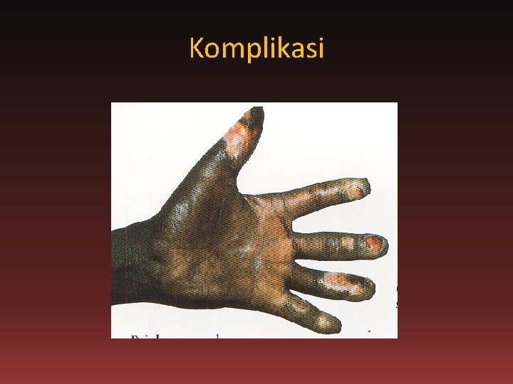 Komplikasi 