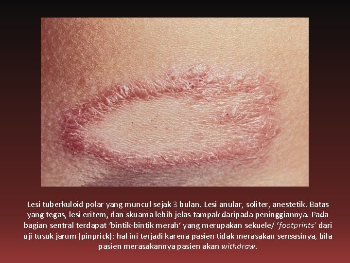 Lesi tuberkuloid polar yang muncul sejak 3 bulan. Lesi anular, soliter, anestetik. Batas yang