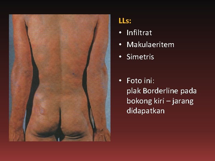 LLs: • Infiltrat • Makulaeritem • Simetris • Foto ini: plak Borderline pada bokong