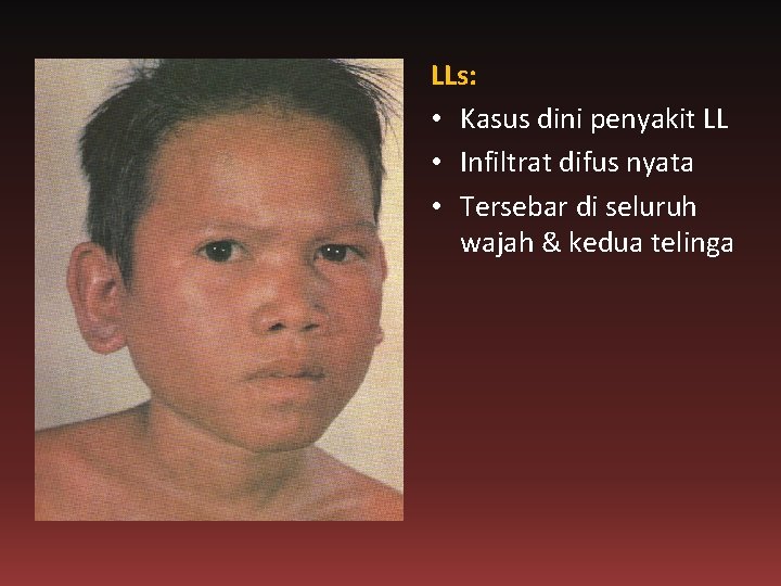 LLs: • Kasus dini penyakit LL • Infiltrat difus nyata • Tersebar di seluruh