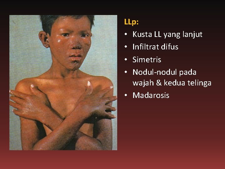 LLp: • Kusta LL yang lanjut • Infiltrat difus • Simetris • Nodul-nodul pada