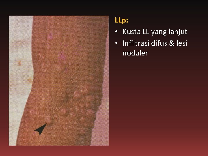 LLp: • Kusta LL yang lanjut • Infiltrasi difus & lesi noduler 