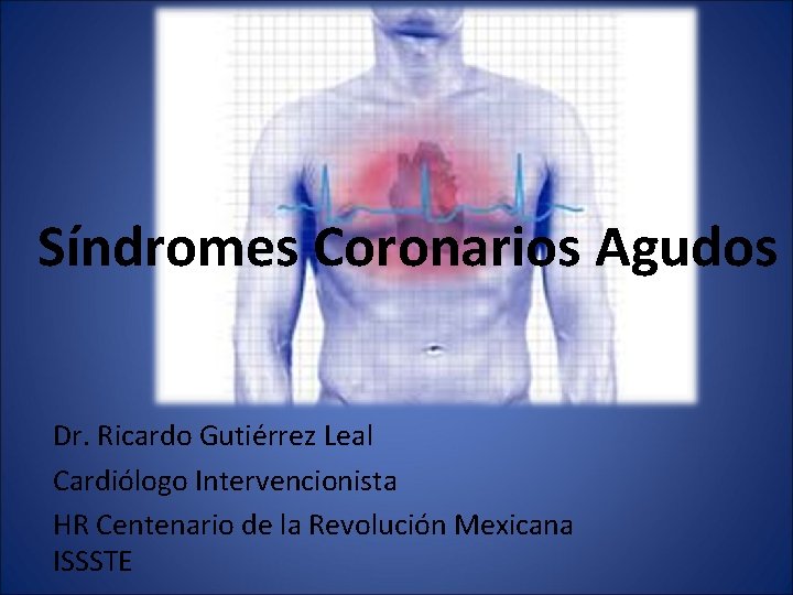 Síndromes Coronarios Agudos Dr. Ricardo Gutiérrez Leal Cardiólogo Intervencionista HR Centenario de la Revolución