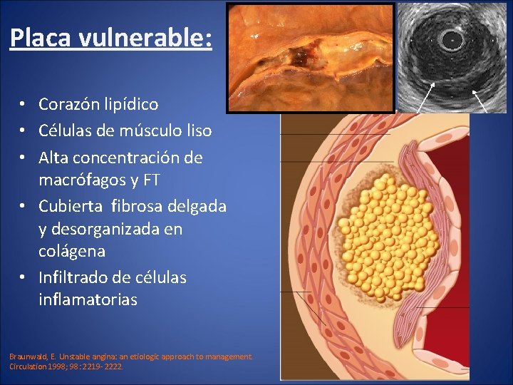 Placa vulnerable: • Corazón lipídico • Células de músculo liso • Alta concentración de