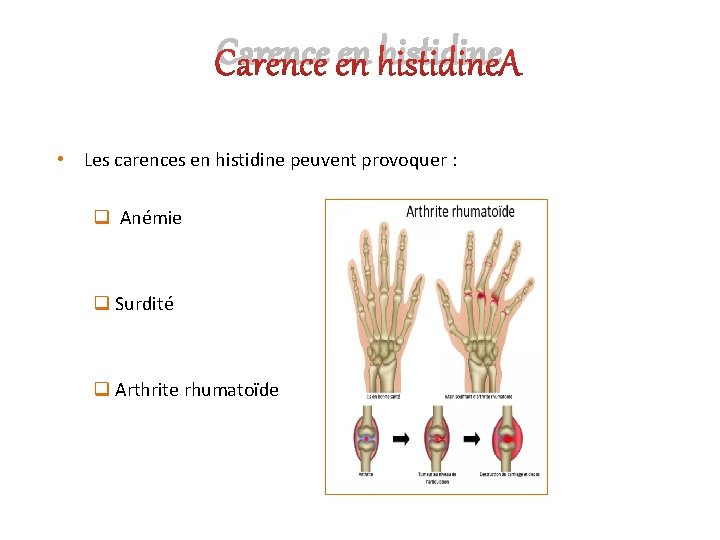 Carence en histidine • Les carences en histidine peuvent provoquer : q Anémie q