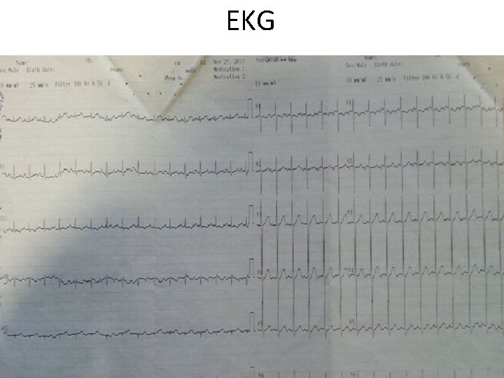 EKG 