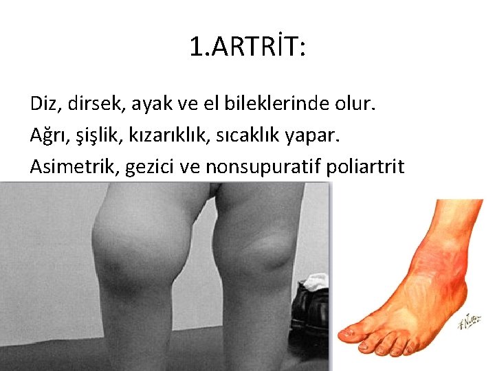1. ARTRİT: Diz, dirsek, ayak ve el bileklerinde olur. Ağrı, şişlik, kızarıklık, sıcaklık yapar.