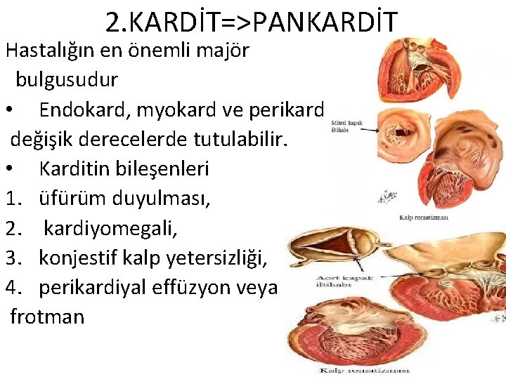 2. KARDİT=>PANKARDİT Hastalığın en önemli majör bulgusudur • Endokard, myokard ve perikard değişik derecelerde