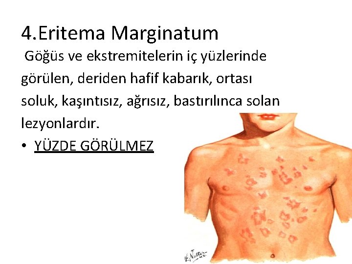 4. Eritema Marginatum Göğüs ve ekstremitelerin iç yüzlerinde görülen, deriden hafif kabarık, ortası soluk,