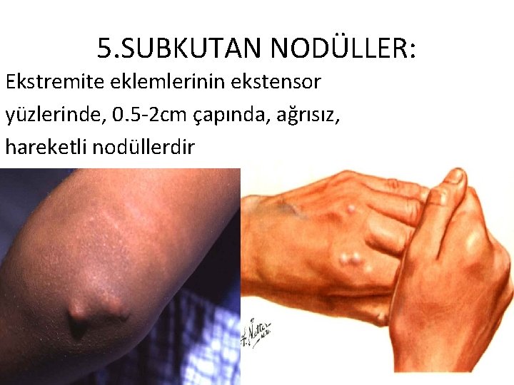 5. SUBKUTAN NODÜLLER: Ekstremite eklemlerinin ekstensor yüzlerinde, 0. 5 -2 cm çapında, ağrısız, hareketli