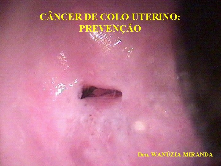 C NCER DE COLO UTERINO: PREVENÇÃO Dra. WANÚZIA MIRANDA 
