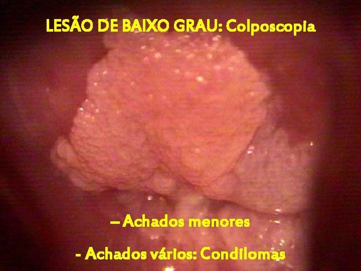 LESÃO DE BAIXO GRAU: Colposcopia – Achados menores - Achados vários: Condilomas 