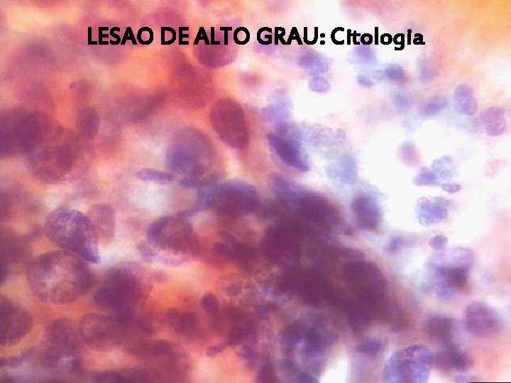 LESAO DE ALTO GRAU: Citologia 