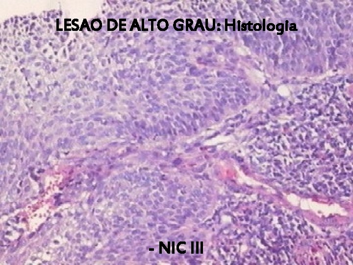 LESAO DE ALTO GRAU: Histologia - NIC III 