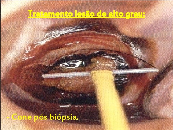 Tratamento lesão de alto grau: - Cone pós biópsia. 