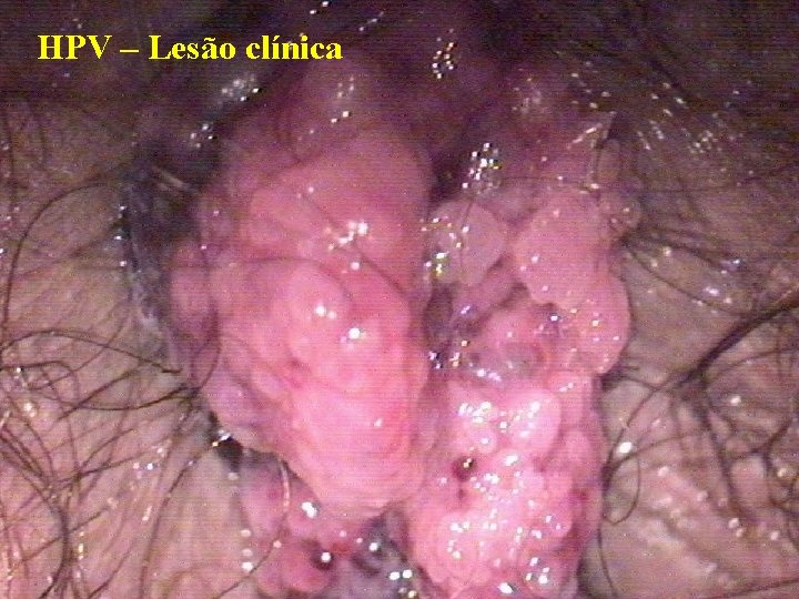 HPV – Lesão clínica 