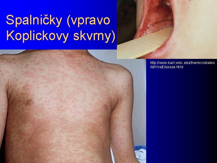 Spalničky (vpravo Koplickovy skvrny) http: //www. bact. wisc. edu/themicrobialwo rld/Viral. Disease. html 