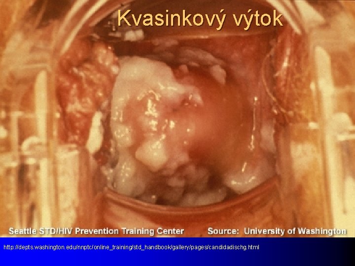 Kvasinkový výtok http: //depts. washington. edu/nnptc/online_training/std_handbook/gallery/pages/candidadischg. html 