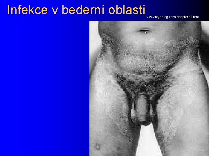 Infekce v bederní oblasti www. mycolog. com/chapter 23. htm 