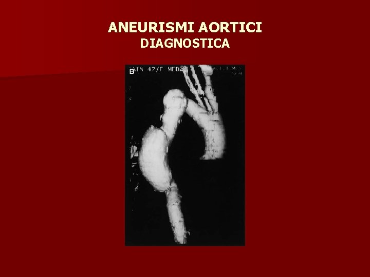 ANEURISMI AORTICI DIAGNOSTICA 