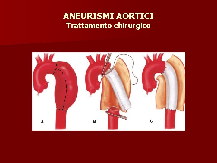 ANEURISMI AORTICI Trattamento chirurgico 