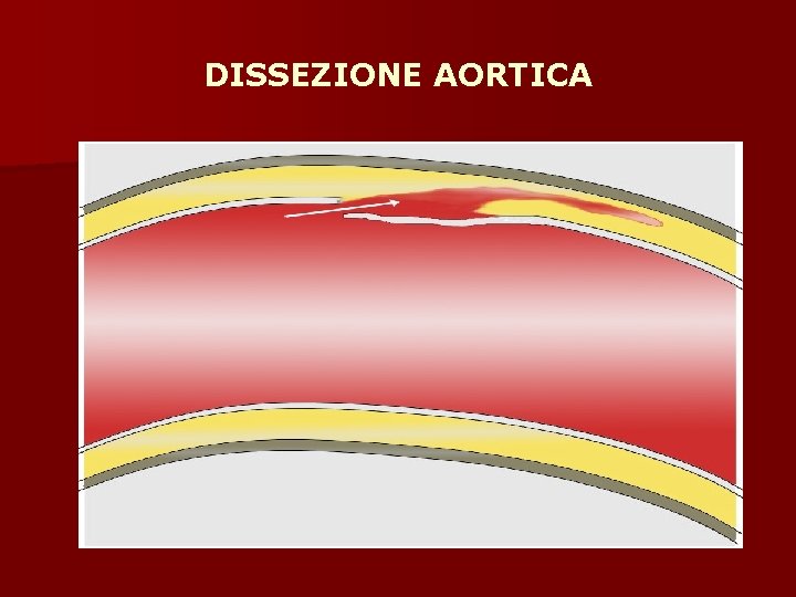 DISSEZIONE AORTICA 