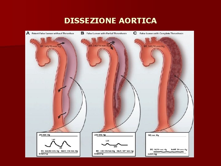 DISSEZIONE AORTICA 