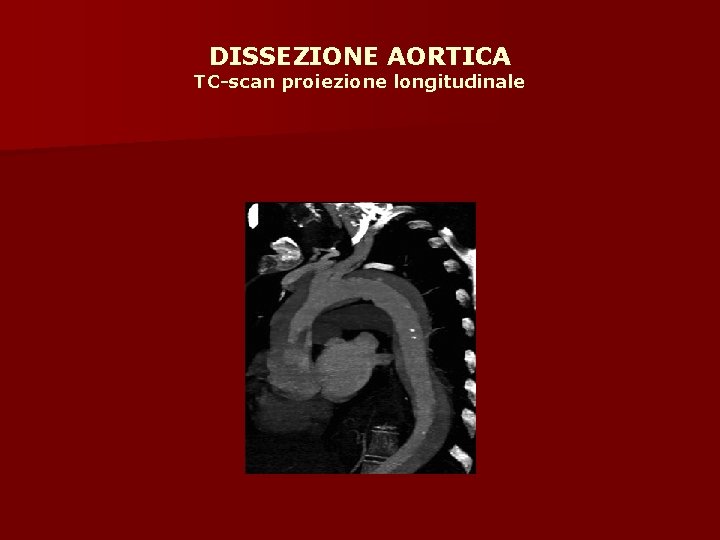 DISSEZIONE AORTICA TC-scan proiezione longitudinale 