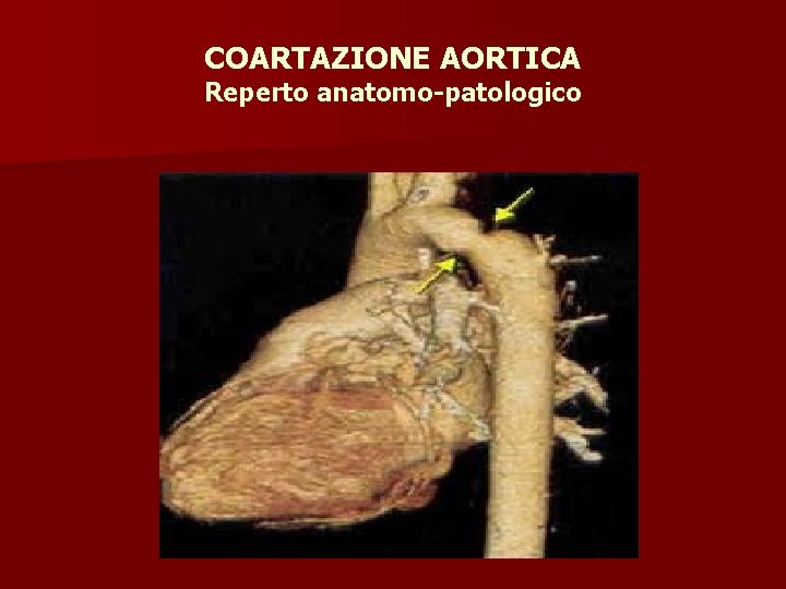COARTAZIONE AORTICA Reperto anatomo-patologico 
