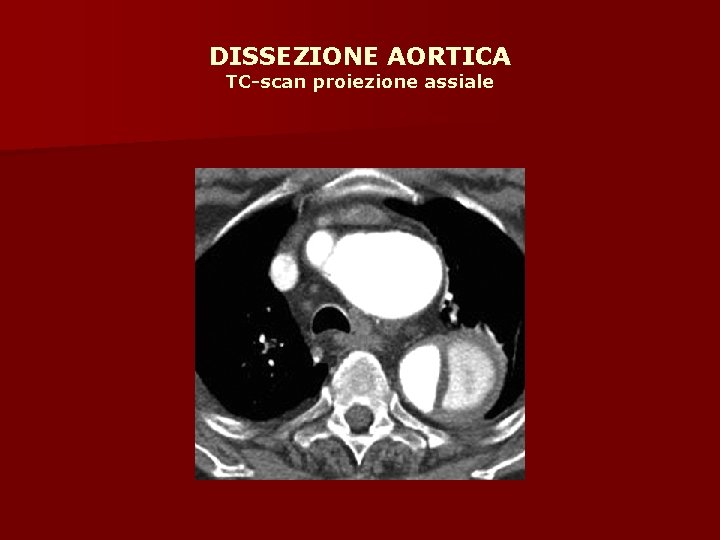 DISSEZIONE AORTICA TC-scan proiezione assiale 