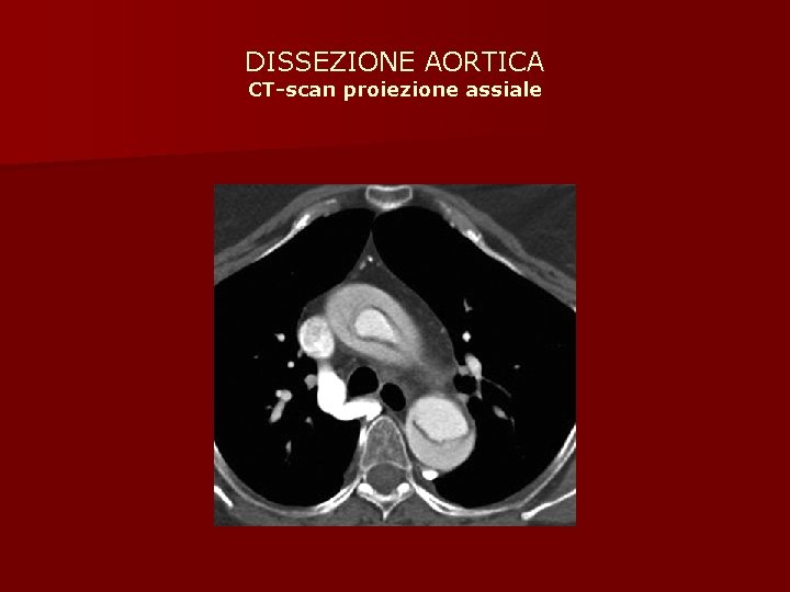 DISSEZIONE AORTICA CT-scan proiezione assiale 