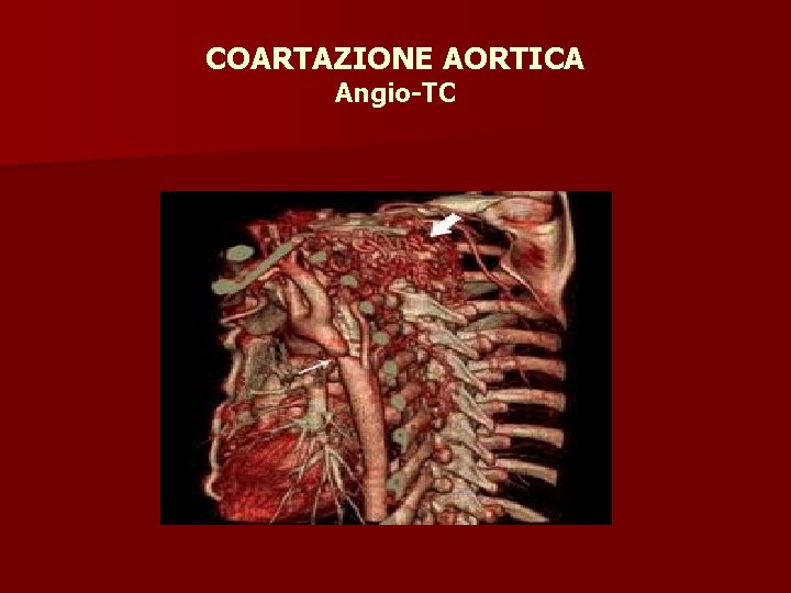 COARTAZIONE AORTICA Angio-TC 