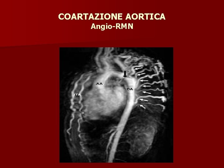 COARTAZIONE AORTICA Angio-RMN 