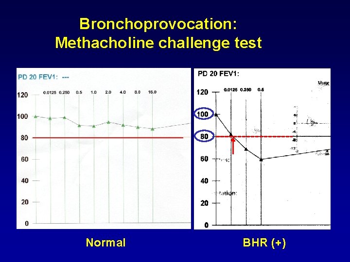 Bronchoprovocation: Methacholine challenge test Normal BHR (+) 