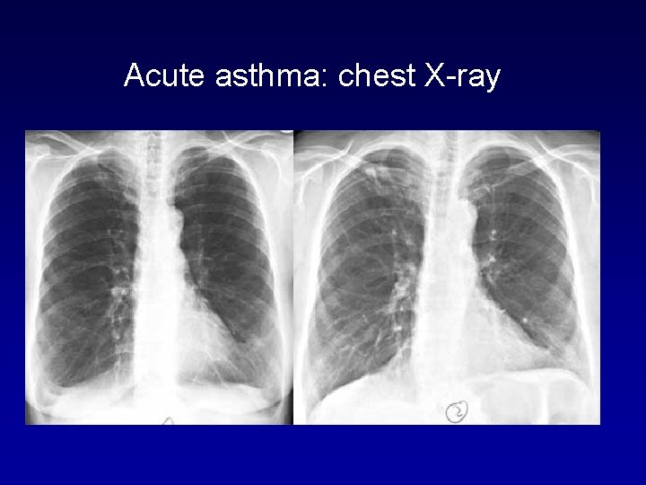 Acute asthma: chest X-ray 