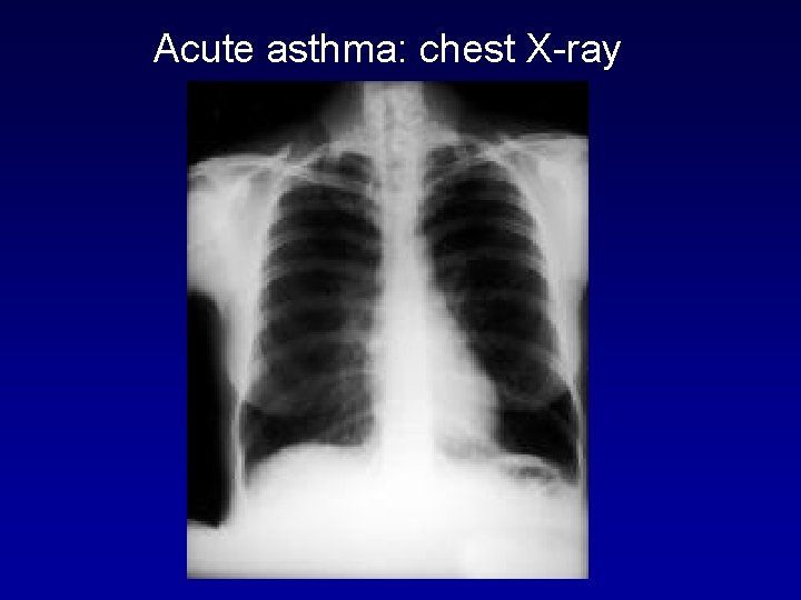 Acute asthma: chest X-ray 